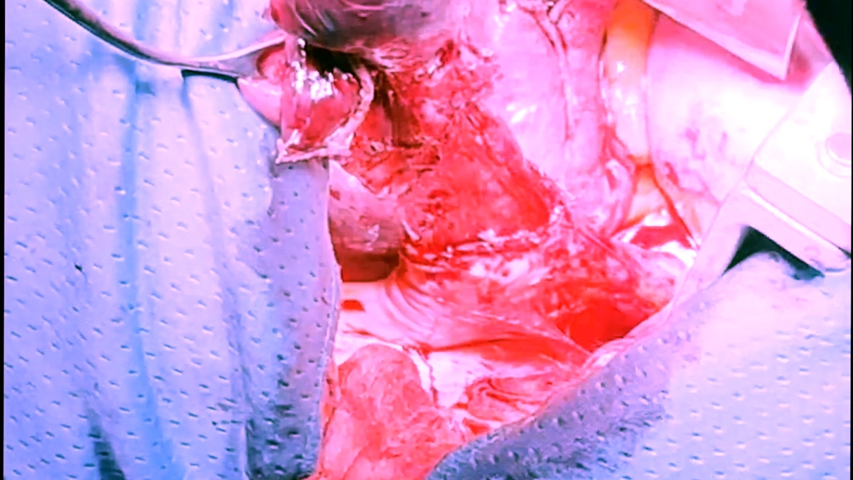 Fistola diverticolo-polmonare (paziente con diverticolo epifrenico e acalasia). Dr. G. Pallabazzer